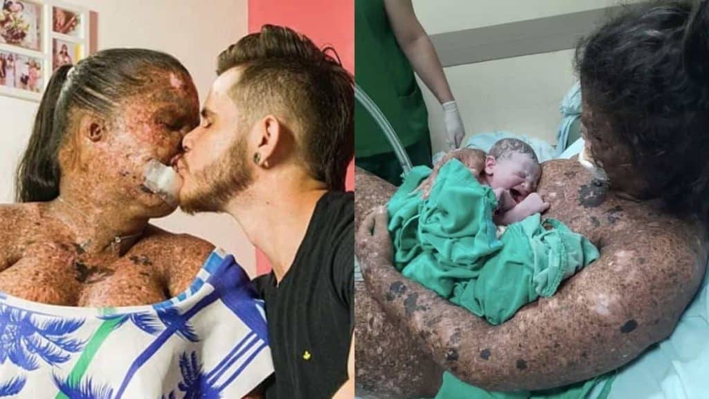 Suffering from a rare skin disease, people accuse her of being “irresponsible”